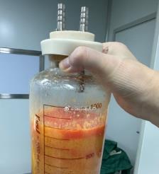 保亭水动力吸脂手术要做多久？
